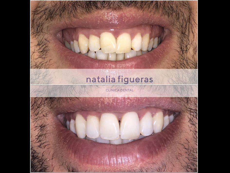 blanqueamiento estética dental en clínica dental Natalia Figueras