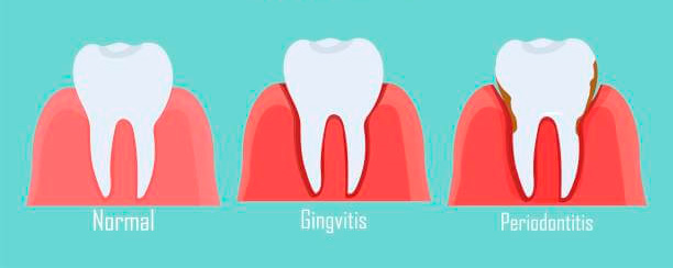 gingivitis, formas de tratarlo