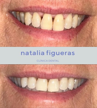 caso clínico del antes y el después de periodontitis grave