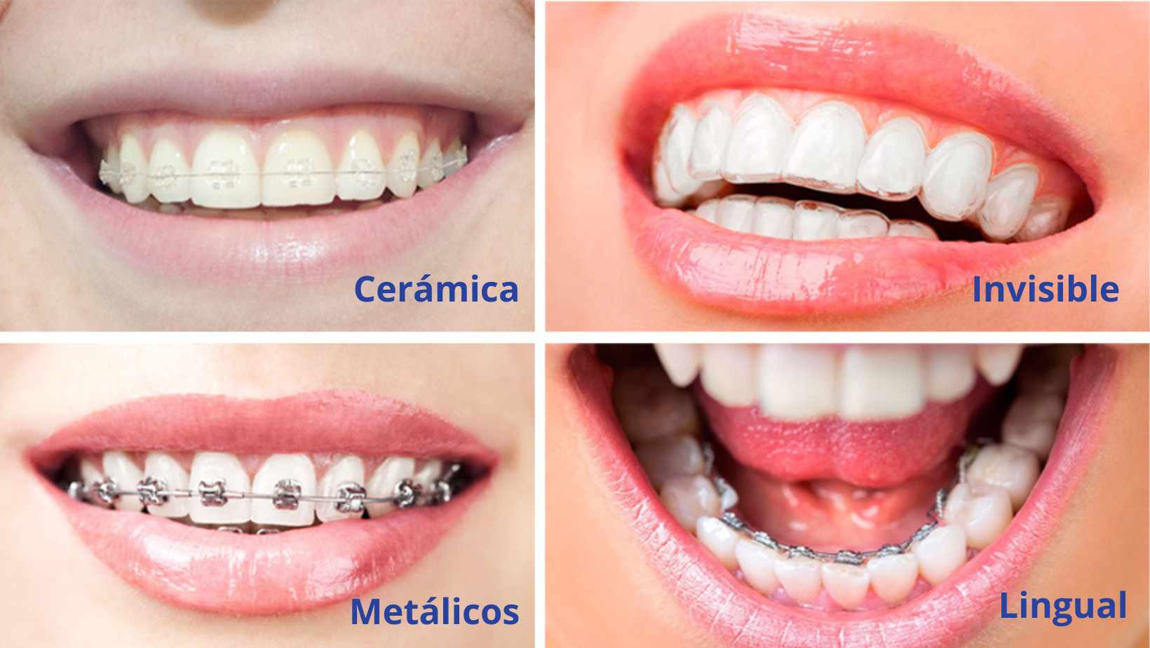 Los diferentes tipos de ortodoncia en la clínica Natalia Figueras