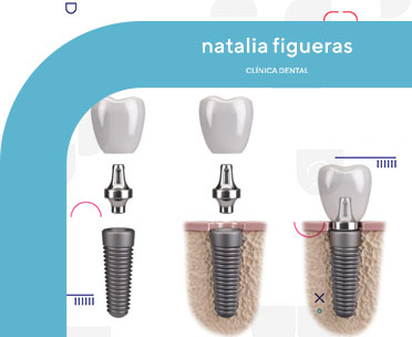 Natalia Figueras clínica dental implantes en dientes